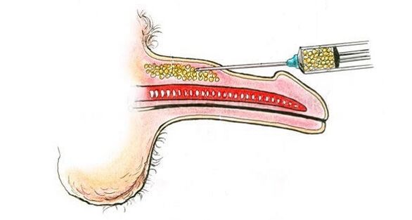 Injecties van hyaluronzuur in het vat van een lid om het te verhogen
